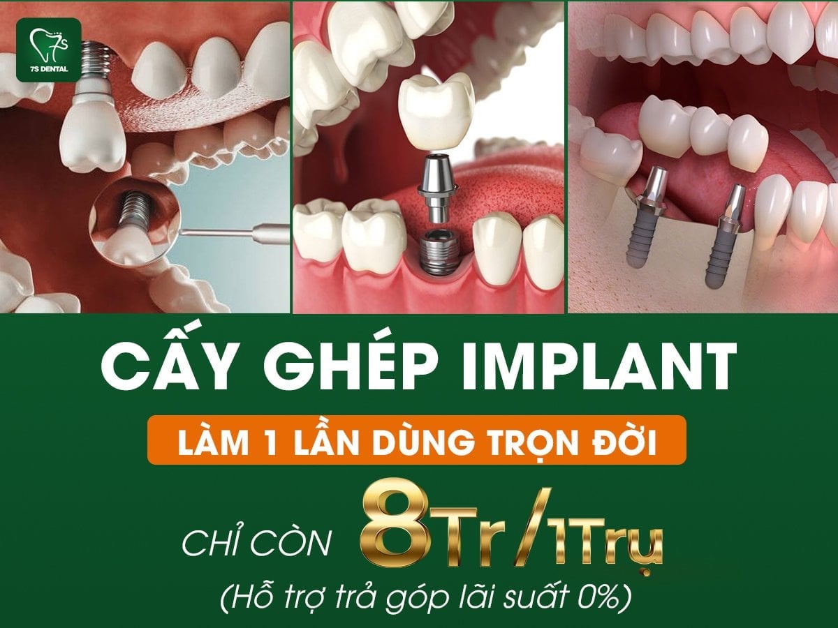 Trụ Implant